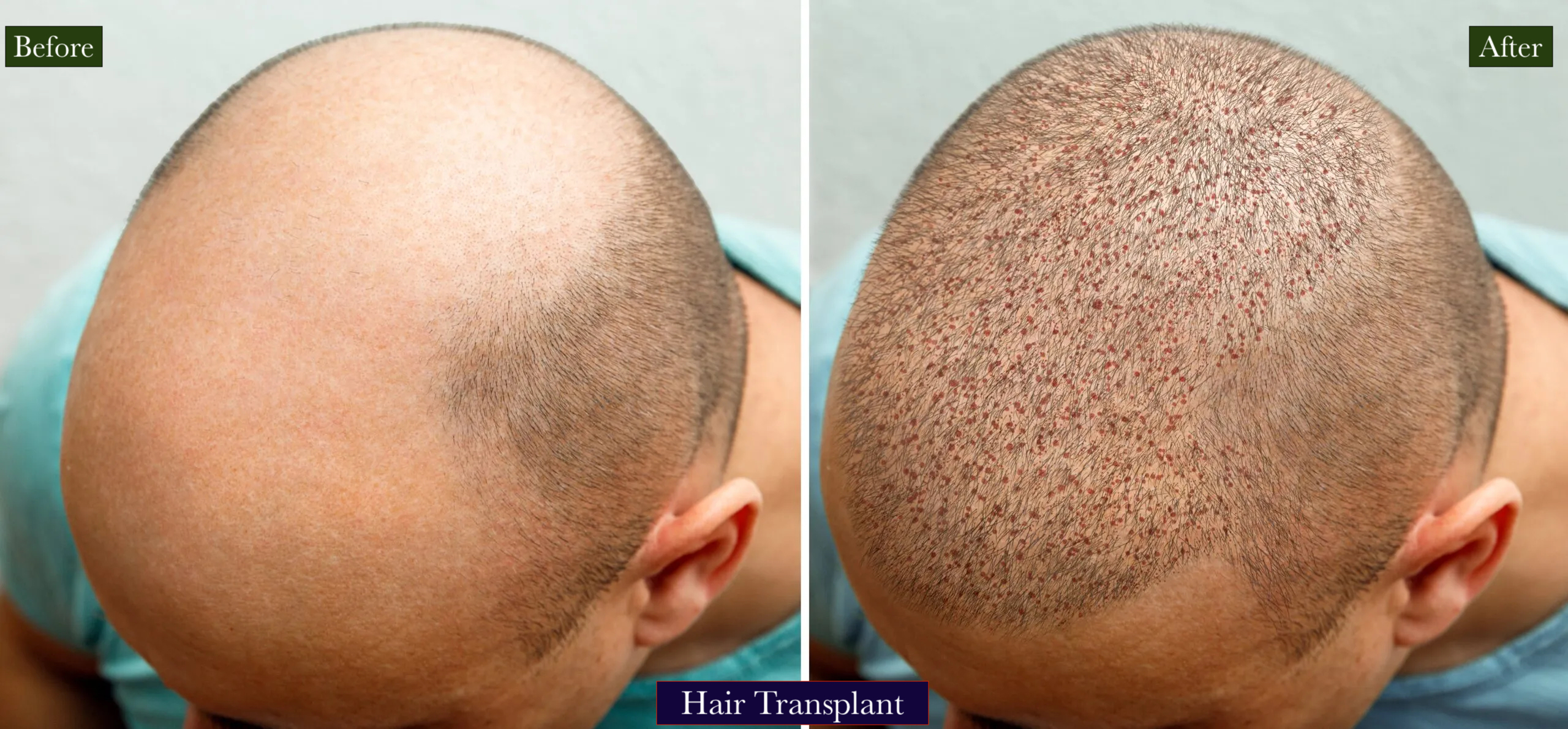 Hair Transplant